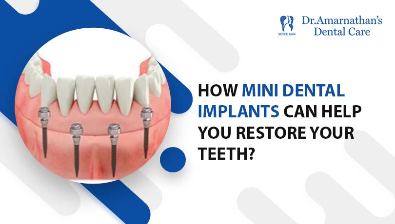 What do you need to know about Mini Dental Implants?